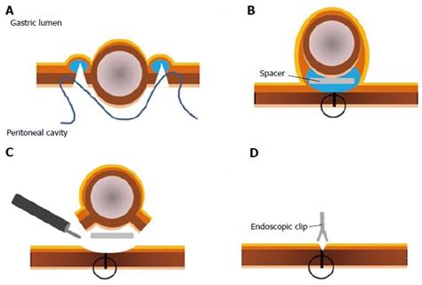 Cutting Edge Of Endoscopic Full Thickness Resection For Gastric Tumor