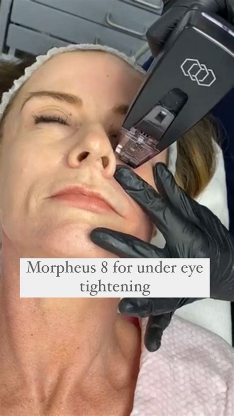 Uma Skinclinic On Instagram Watch This Morpheus Radio Frequency