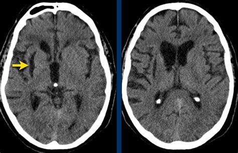 The Radiology Assistant Non Traumatic Intracranial Hemorrhage