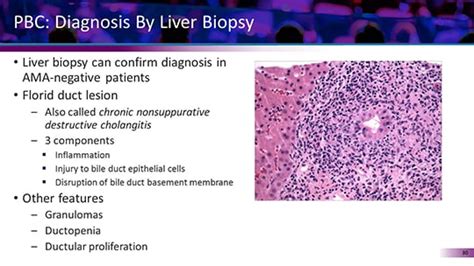 Solving The Pbc Mystery From Missing Clues To Diagnosis And Improved Treatment Transcript