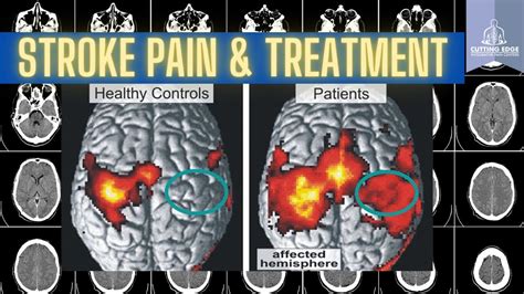 Central post stroke pain, again sorry - Page 10 - Diagnosis and ...