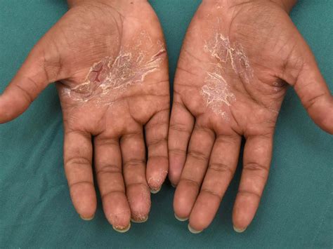 Atopic Dermatitis Hands Treatment