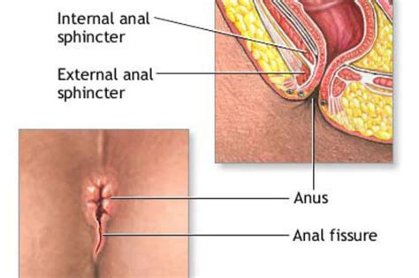 Anal Fissure Signs Telegraph