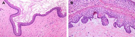 Nevoid Basal Cell Carcinoma Syndrome Histology