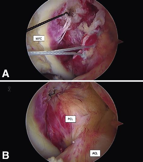 A Arthroscopic Image Viewing From The Anterolateral Portal Of The