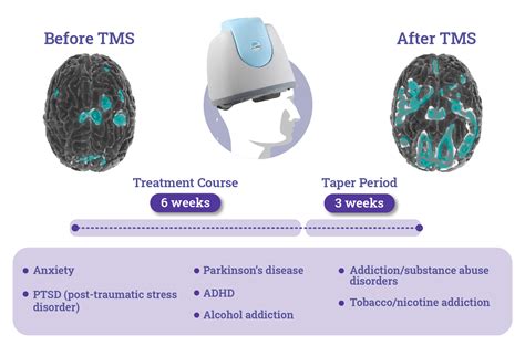 What Is Tms Therapy Madison Avenue Tms And Psychiatry