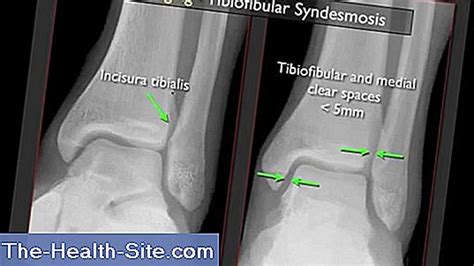 Syndesmotic Ligament Tear - What Is Syndesmosis? 💊 Scientific-Practical Medical Journal - 2023