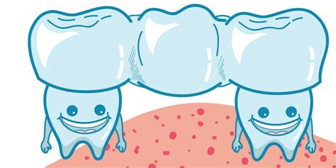 Ways To Prevent The 4 Most Common Dental Bridge Problems - Keep 28 Dental