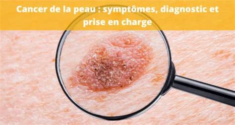 Cancer De La Peau Sympt Mes Diagnostics Traitements Et Taux De Survie