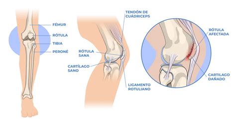 Cu Nto Tiempo De Baja Por Condromalacia Rotuliana Es Recomendable Tomar