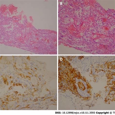 Haematoxylin and eosin staining of a tumour section. A: Under × 10 ...