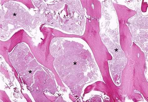 Pathology Outlines - Avascular necrosis