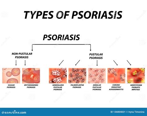 types  psoriasis   pamela adkins blog