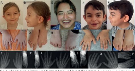 Figure From The Clinical And Molecular Features Of Three Turkish