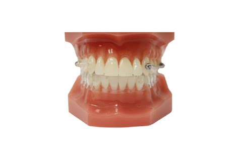 Motion 3d™ Class Ii Appliance Henry Schein® Orthodontics