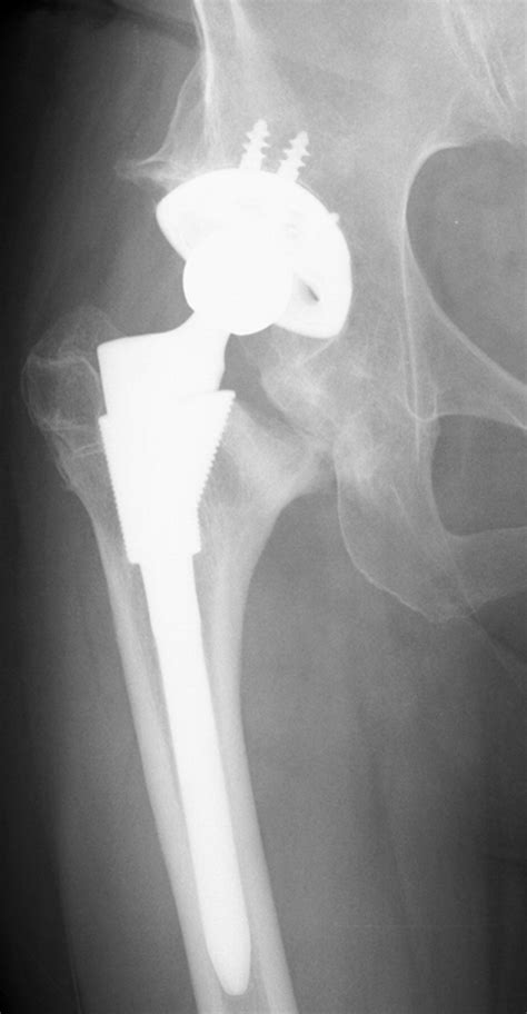 Cementless Total Hip Replacement After Previous Intertrochanteric