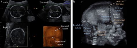 Fetal Skull Ultrasound