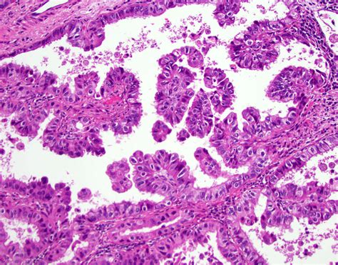 Pathology Outlines Adenocarcinoma Overview