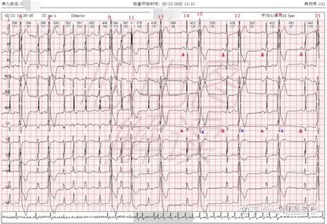 今天要分享的心电图 阵发性房颤室早二联律 知乎