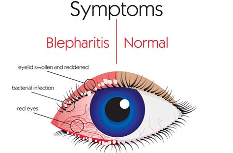 Keeping Eyelids Healthy: The Importance of Eyelid Hygiene