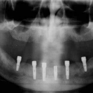 Comparison Of Ideal And Achieved Implant Distance And Angulation