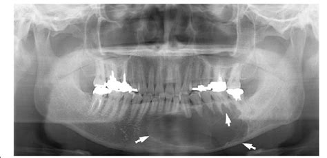 A Panoramic Radiograph Exhibiting A Multilocular Radiolucency In The