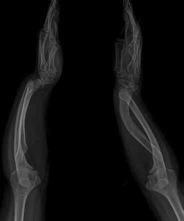 Bilateral Madelung Deformity Image Radiopaedia Org