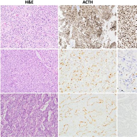 Immunohistochemical Expression Of Acth And Tpit In Corticotroph Pitnet