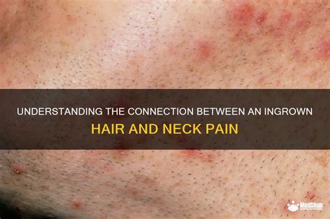 Understanding The Connection Between An Ingrown Hair And Neck Pain