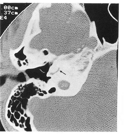 Ct Scan Axial Plane Of The Right Temporal Bone Showing An Example Of