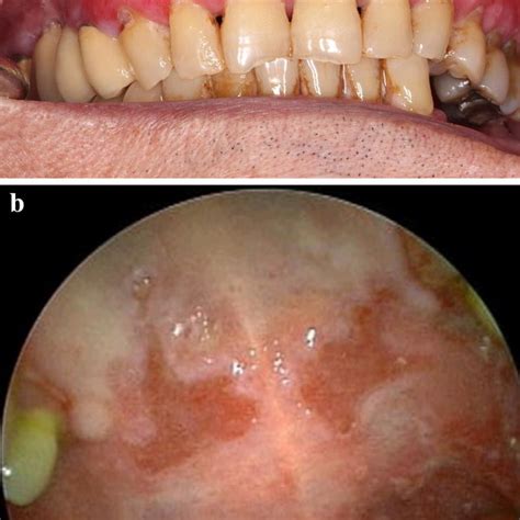 a MMP of nasal mucosa involvement with crusting and erosions. b MMP of ...