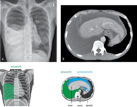 Figuur A R Ntgenfoto Van De Thorax Van Pati Nt A Met Pleuravocht
