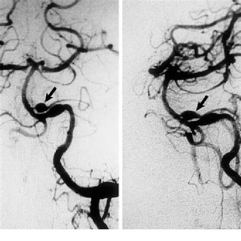 Preoperative Left Vertebral Angiograms Anteroposterior Left And