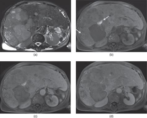 Liver metastases | Radiology Key