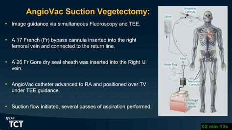 Tct Debulking Tricuspid Valve Vegetations Using Angiovac To Avoid