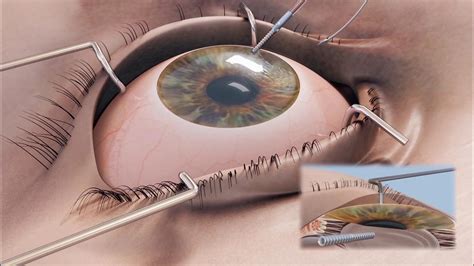 Corneal And Trephines Cornea Graft Transplant Surgical Procedure Cornonet