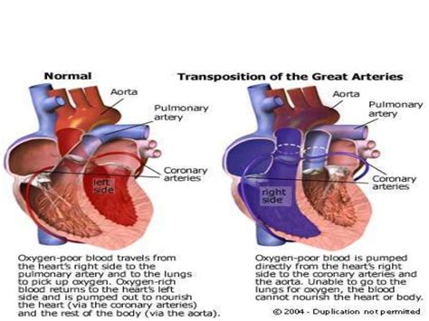 Cyanotic And Acyanotic Congenital Heart Disease For Undergraduated St