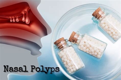 Nasal Polyps Homeopathic Medicine Atelier Yuwa Ciao Jp