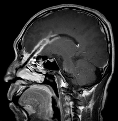 T1 Gadolinium Enhanced Brain Magnetic Resonance Image With A Sagittal