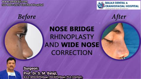 Nose Bridge Rhinoplasty And Wide Nose Correction Youtube