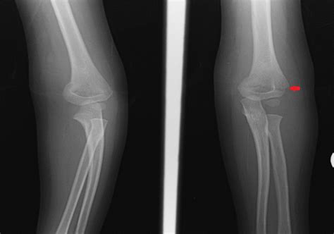 Supracondylar Humerus Fractures Treatment Management Point Of Care