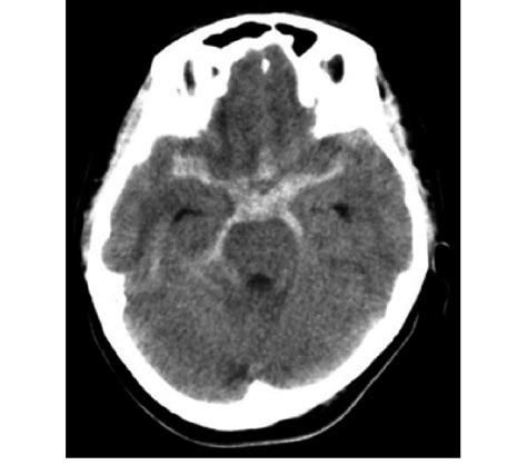 Axial Computed Tomography Showing A Diffuse Subarachnoid Hemorrhage In