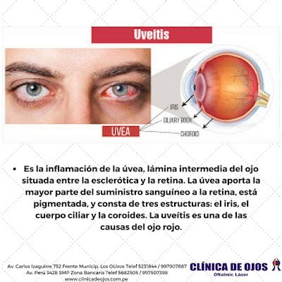 Clínica de Ojos Oftalmic Láser UVEÍTIS