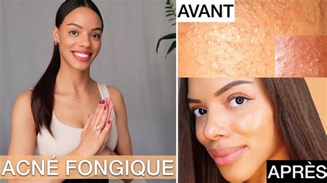 S O S Peau Granuleuse Rugueuse Acn Fongique Routine Tous Types De