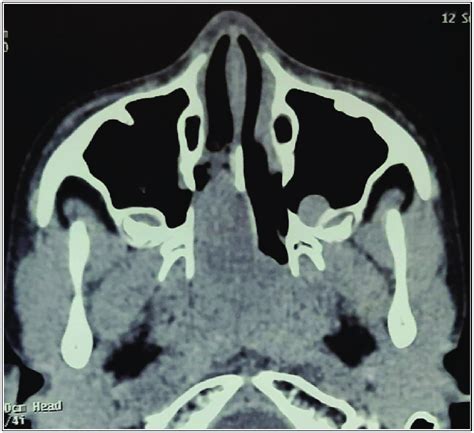 Ct Scan Of The Nose And Paranasal Sinus Showing Radioopaque Mass In The