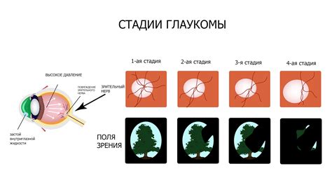 Глаукома: причины заболевания, симптомы, стадии и лечение