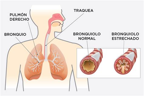 EPOC enfermedad pulmonar obstructiva crónica Bupa Latam