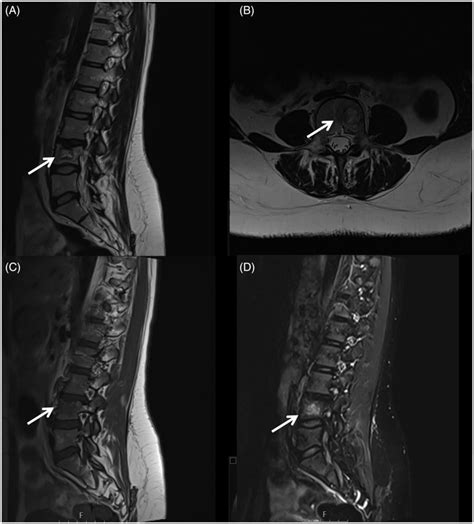 MRI at follow up- 16 months after the diagnosis. (A) This is a sagittal ...