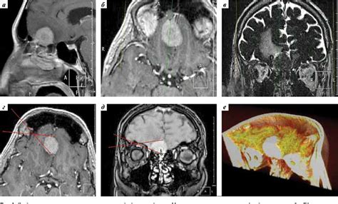 Figure 1 From Fully Endoscopic Transcranial Removal Of Anterior Fossa