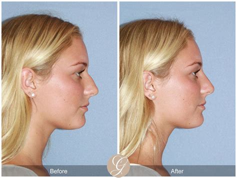 Pics Just After Rhinoplasty